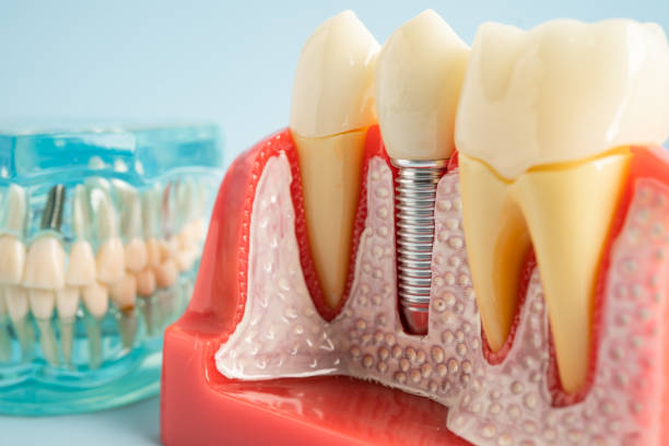 Best Dental Inlays and Onlays  in Hanover, OH